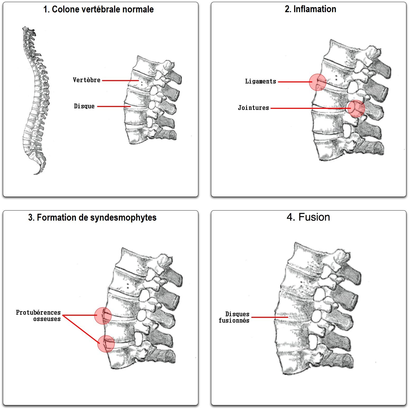 Spondylarthrite ankylosante : maladie de la colonne vertébrale et des articulations